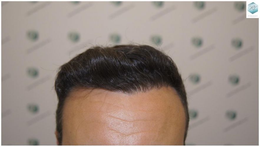 Injerto Capilar Técnica FUE 1.683 Grafts (Pelos 3705) 36 DESPUES DE UN TRASPLANTE DE PELO