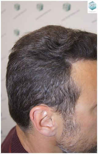 Injerto Capilar Técnica FUE 1.683 Grafts (Pelos 3705) 45 DESPUES DE UN TRASPLANTE DE PELO