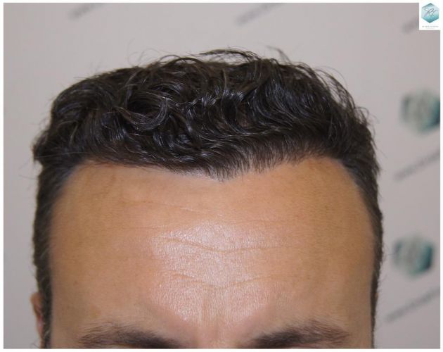 Injerto Capilar Técnica FUE 1.683 Grafts (Pelos 3705) 54 DESPUES DE UN TRASPLANTE DE PELO