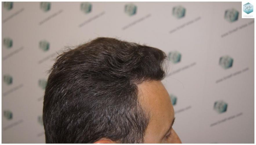 Injerto Capilar Técnica FUE 1.683 Grafts (Pelos 3705) 44 DESPUES DE UN TRASPLANTE DE PELO