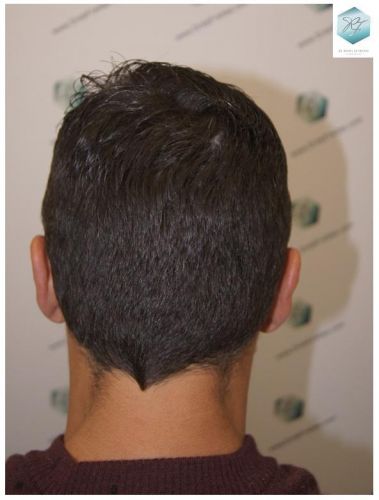 Injerto Capilar Técnica FUE 1.683 Grafts (Pelos 3705) 57 DESPUES DE UN TRASPLANTE DE PELO