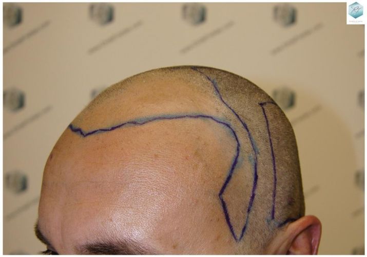 Injerto Capilar Técnica FUE 1.683 Grafts (Pelos 3705) 17 TECNICA FUE