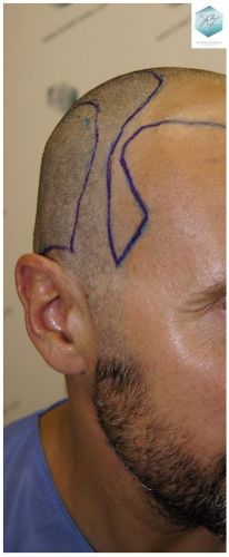 Injerto Capilar Técnica FUE 1.683 Grafts (Pelos 3705) 14 TECNICA FUE