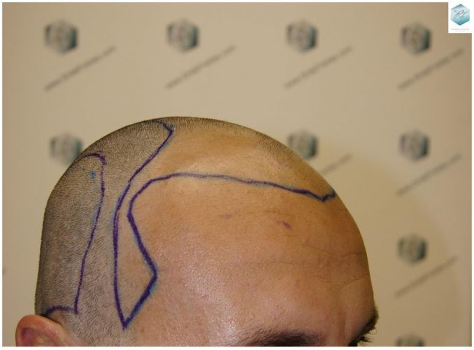 Injerto Capilar Técnica FUE 1.683 Grafts (Pelos 3705) 15 TECNICA FUE