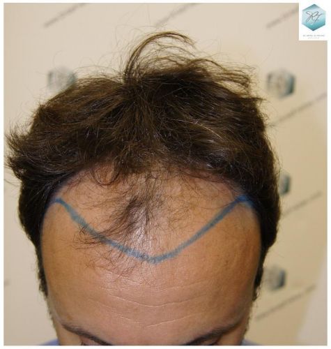 Injerto Capilar Técnica FUE 1.683 Grafts (Pelos 3705) 7 TECNICA FUE