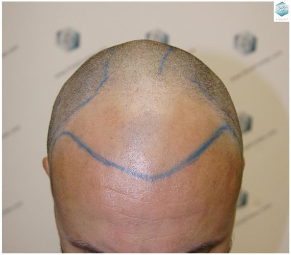 Injerto Capilar Técnica FUE 1.683 Grafts (Pelos 3705) 12 TECNICA FUE