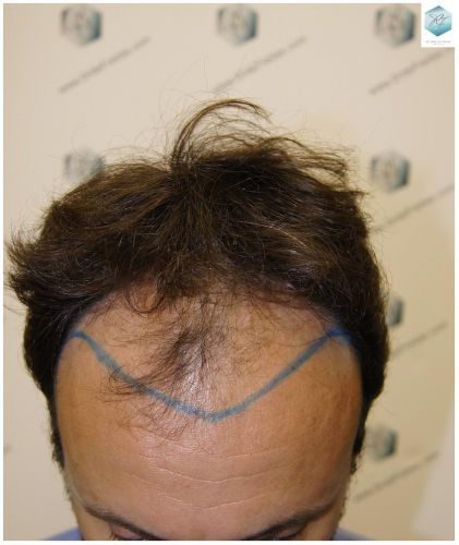 Injerto Capilar Técnica FUE 1.683 Grafts (Pelos 3705) 8 TECNICA FUE