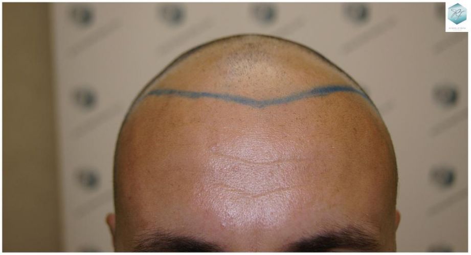 Injerto Capilar Técnica FUE 1.683 Grafts (Pelos 3705) 11 TECNICA FUE