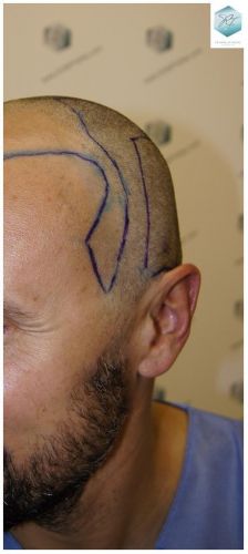 Injerto Capilar Técnica FUE 1.683 Grafts (Pelos 3705) 16 TECNICA FUE