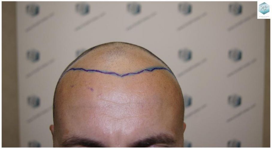 Injerto Capilar Técnica FUE 1.683 Grafts (Pelos 3705) 13 TECNICA FUE