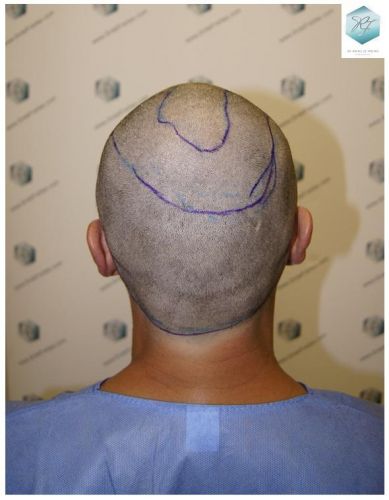 Injerto Capilar Técnica FUE 1.683 Grafts (Pelos 3705) 18 TECNICA FUE