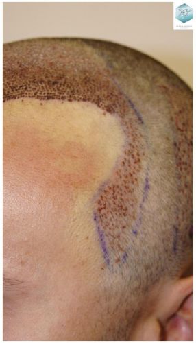 Injerto Capilar Técnica FUE 1.683 Grafts (Pelos 3705) 31 TECNICA FUE