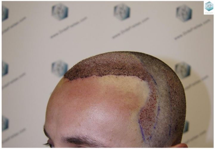 Injerto Capilar Técnica FUE 1.683 Grafts (Pelos 3705) 27 DESPUES DE UN TRASPLANTE DE PELO