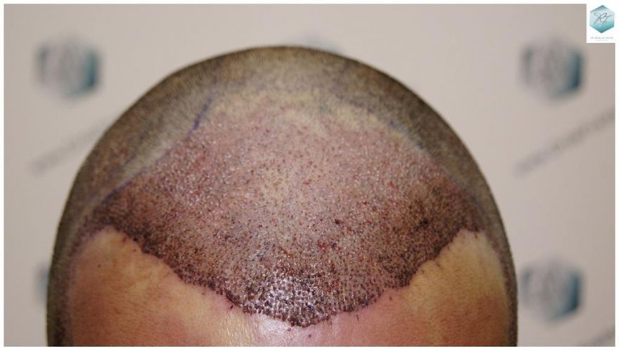 Injerto Capilar Técnica FUE 1.683 Grafts (Pelos 3705) 22 DESPUES DE UN TRASPLANTE DE PELO
