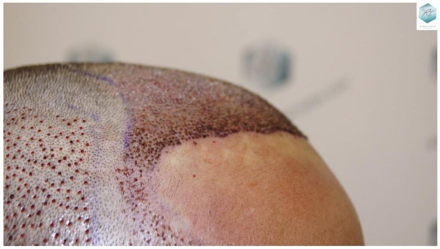 Injerto Capilar Técnica FUE 1.683 Grafts (Pelos 3705) 25 DESPUES DE UN TRASPLANTE DE PELO