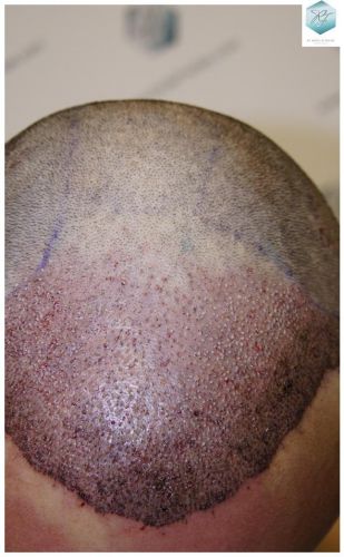 Injerto Capilar Técnica FUE 1.683 Grafts (Pelos 3705) 23 DESPUES DE UN TRASPLANTE DE PELO