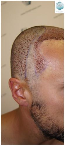 Injerto Capilar Técnica FUE 1.683 Grafts (Pelos 3705) 24 DESPUES DE UN TRASPLANTE DE PELO
