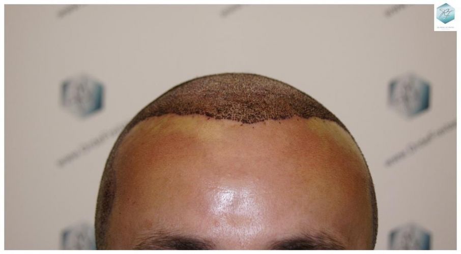 TRASPLANTE CAPILAR DESPUES DE UN TRASPLANTE DE PELO