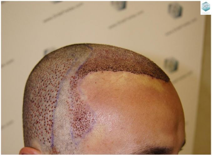 Injerto Capilar Técnica FUE 1.683 Grafts (Pelos 3705) 20 TECNICA FUE