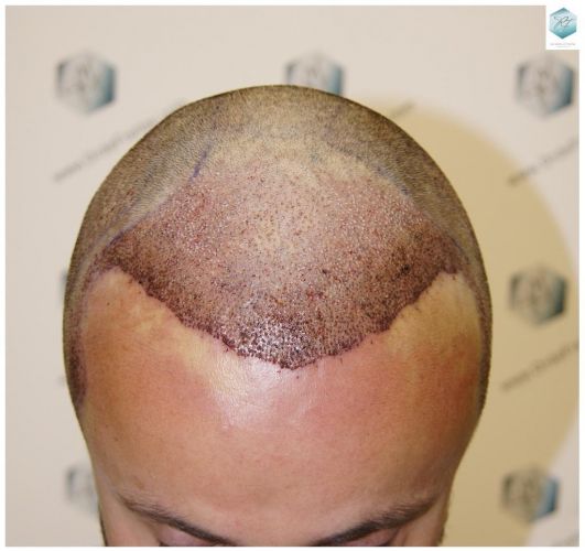 Injerto Capilar Técnica FUE 1.683 Grafts (Pelos 3705) 19 TECNICA FUE