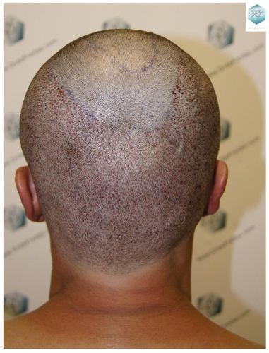 Injerto Capilar Técnica FUE 1.683 Grafts (Pelos 3705) 32 DESPUES DE UN TRASPLANTE DE PELO