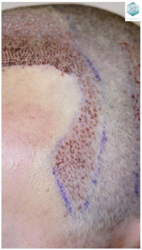Injerto Capilar Técnica FUE 1.683 Grafts (Pelos 3705) 30 DESPUES DE UN TRASPLANTE DE PELO