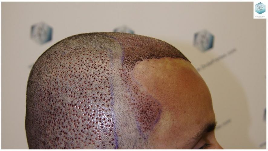 Injerto Capilar Técnica FUE 1.683 Grafts (Pelos 3705) 21 DESPUES DE UN TRASPLANTE DE PELO