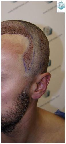 Injerto Capilar Técnica FUE 1.683 Grafts (Pelos 3705) 29 DESPUES DE UN TRASPLANTE DE PELO