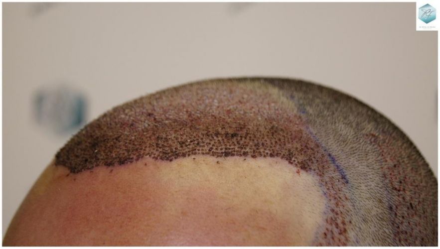 Injerto Capilar Técnica FUE 1.683 Grafts (Pelos 3705) 28 DESPUES DE UN TRASPLANTE DE PELO