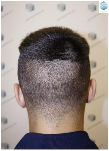 Injerto Capilar Técnica FUE 1683 Grafts 3705 Pelos 30 INJERTO CAPILAR