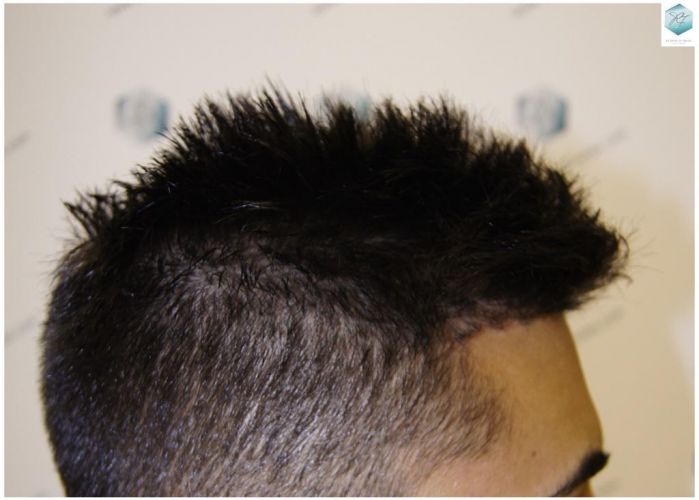Injerto Capilar Técnica FUE 1683 Grafts 3705 Pelos 27 INJERTO CAPILAR