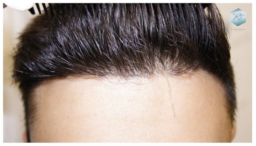 Injerto Capilar Técnica FUE 1683 Grafts 3705 Pelos 18 INJERTO CAPILAR