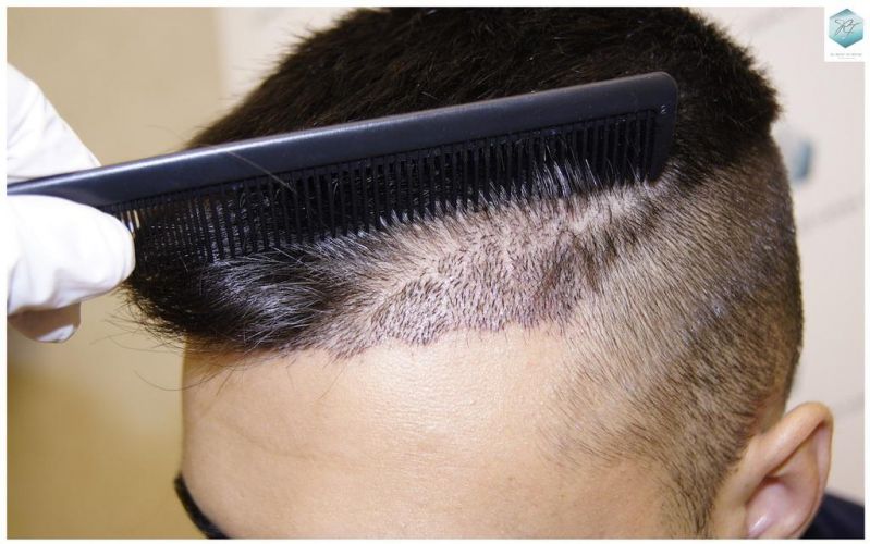 Injerto Capilar Técnica FUE 1683 Grafts 3705 Pelos 13 INJERTO CAPILAR