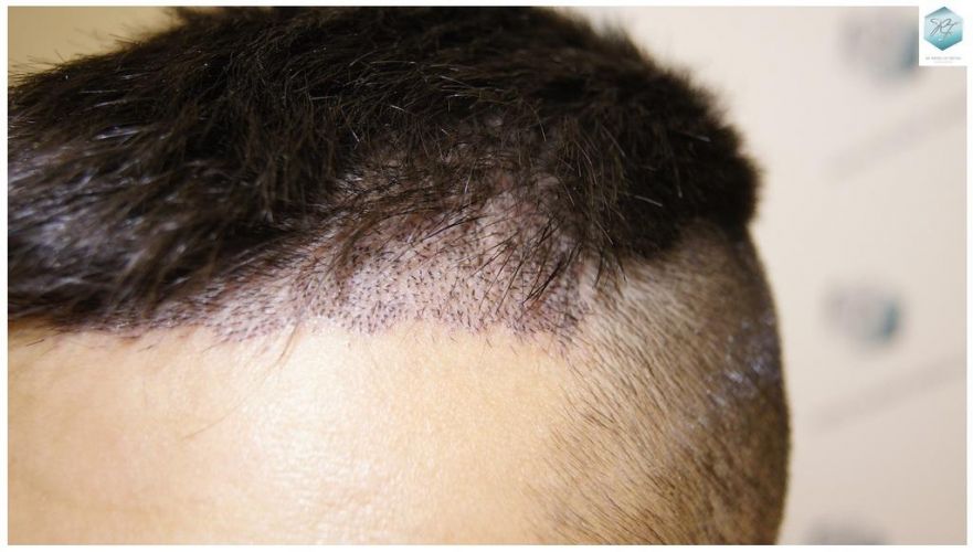 Injerto Capilar Técnica FUE 1683 Grafts 3705 Pelos 14 INJERTO CAPILAR