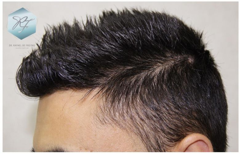 Injerto Capilar Técnica FUE 1683 Grafts 3705 Pelos 24 INJERTO CAPILAR