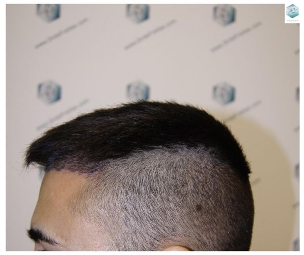 Injerto Capilar Técnica FUE 1683 Grafts 3705 Pelos 9 INJERTO CAPILAR