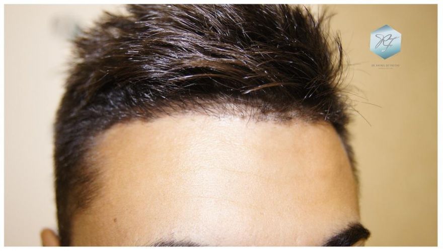 Injerto Capilar Técnica FUE 1683 Grafts 3705 Pelos 19 INJERTO CAPILAR