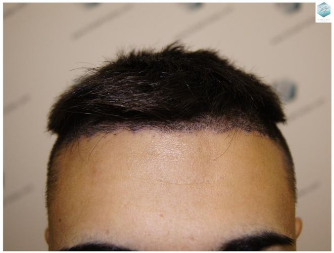 Injerto Capilar Técnica FUE 1683 Grafts 3705 Pelos 16 INJERTO CAPILAR