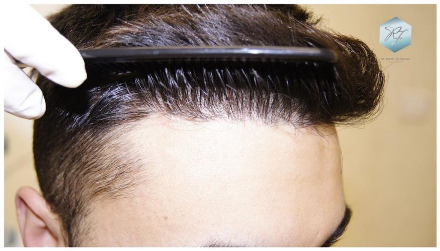 Injerto Capilar Técnica FUE 1683 Grafts 3705 Pelos 20 INJERTO CAPILAR