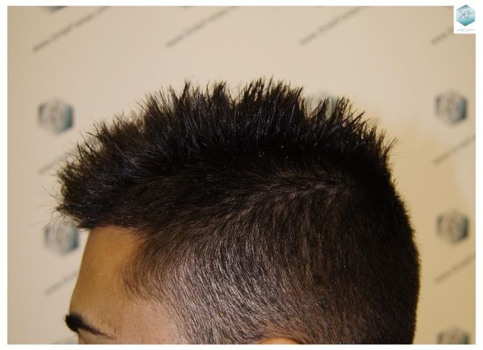 Injerto Capilar Técnica FUE 1683 Grafts 3705 Pelos 26 INJERTO CAPILAR