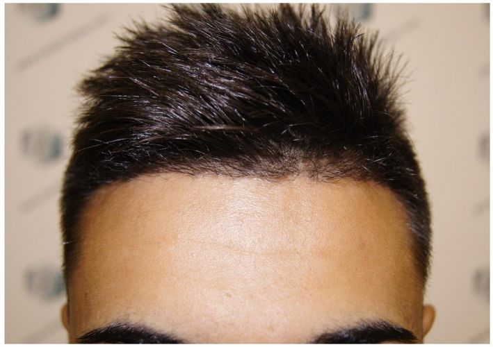 Injerto Capilar Técnica FUE 1683 Grafts 3705 Pelos 15 INJERTO CAPILAR
