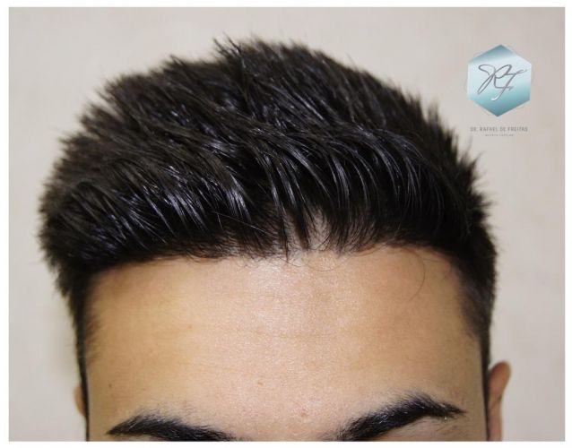 Injerto Capilar Técnica FUE 1683 Grafts 3705 Pelos 17 INJERTO CAPILAR