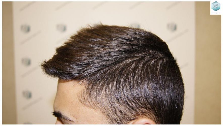 Injerto Capilar Técnica FUE 1683 Grafts 3705 Pelos 25 INJERTO CAPILAR