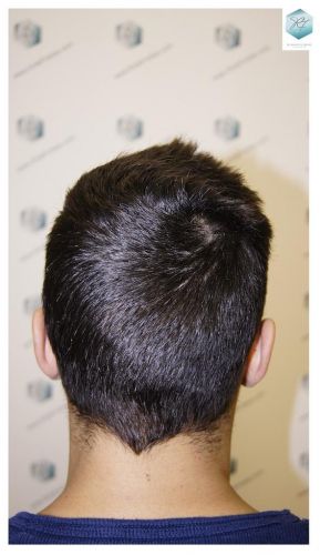 Injerto Capilar Técnica FUE 1683 Grafts 3705 Pelos 3 INJERTO CAPILAR
