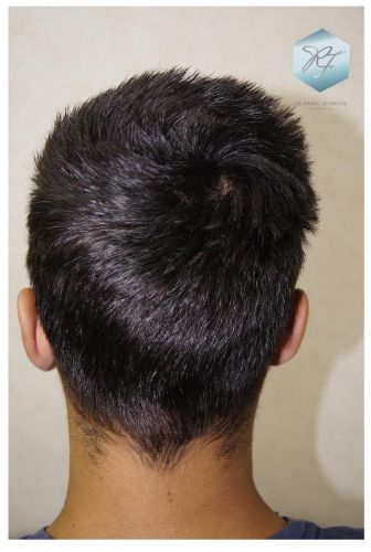 Injerto Capilar Técnica FUE 1683 Grafts 3705 Pelos 31 INJERTO CAPILAR