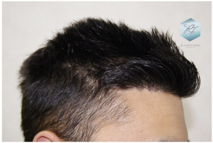 Injerto Capilar Técnica FUE 1683 Grafts 3705 Pelos 22 INJERTO CAPILAR