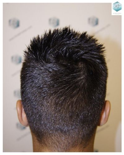 Injerto Capilar Técnica FUE 1683 Grafts 3705 Pelos 32 INJERTO CAPILAR