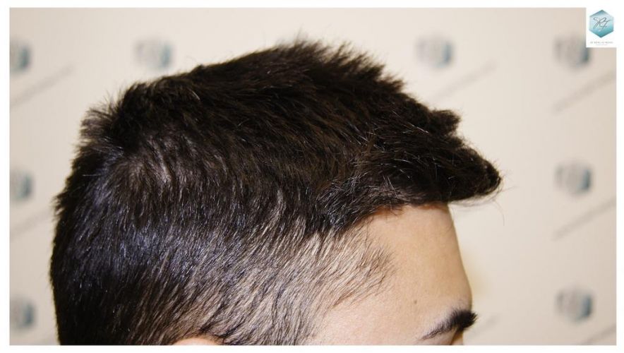 Injerto Capilar Técnica FUE 1683 Grafts 3705 Pelos 21 INJERTO CAPILAR