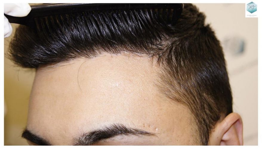 Injerto Capilar Técnica FUE 1683 Grafts 3705 Pelos 23 INJERTO CAPILAR