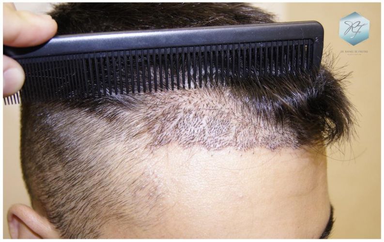 Injerto Capilar Técnica FUE 1683 Grafts 3705 Pelos 12 INJERTO CAPILAR